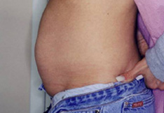 Before Liposuction