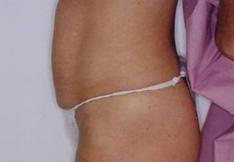 After Liposuction