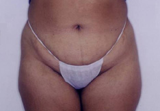 After Liposuction