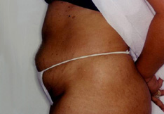 Before Liposuction