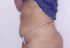 After Liposuction