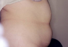 Before Liposuction
