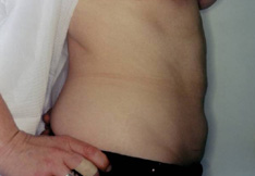 After Liposuction