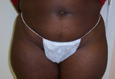 Before Liposuction