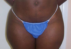 After Liposuction