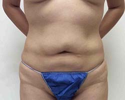 Before Liposuction