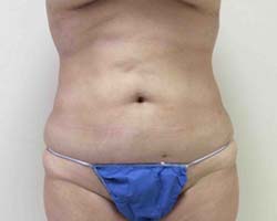 After Liposuction