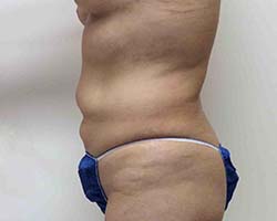 Before Liposuction