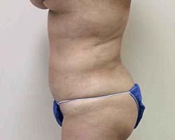 After Liposuction