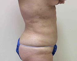 After Liposuction