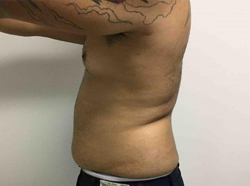 Liposuction Before, Montclair, NJ and New York (NY)