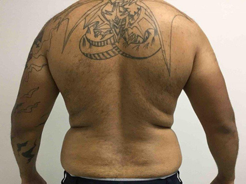 Liposuction Before, Montclair, NJ and New York (NY)