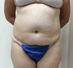 Before SculpSure® WarmSculpting™