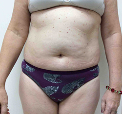 After SculpSure® WarmSculpting™