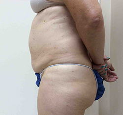 Before SculpSure® WarmSculpting™