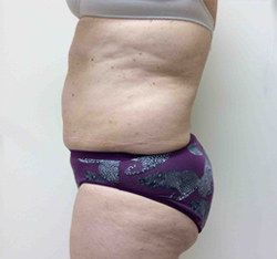 After SculpSure® WarmSculpting™