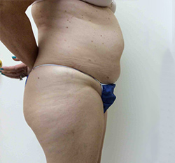 Before SculpSure® WarmSculpting™