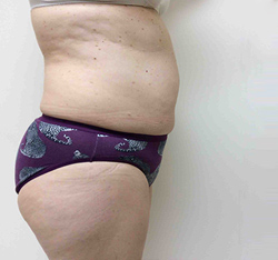 After SculpSure® WarmSculpting™
