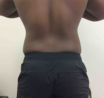 Before SculpSure® WarmSculpting™