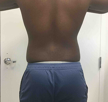 After SculpSure® WarmSculpting™