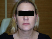 After SmartLipo™
