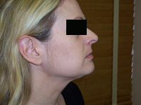 After SmartLipo™