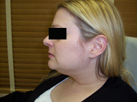 Before SmartLipo™
