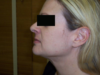 After SmartLipo™