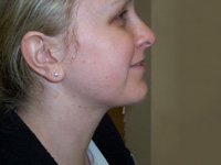 After SmartLipo™