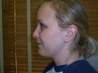 Before SmartLipo™