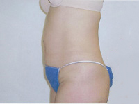Before SmartLipo™