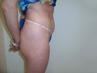 Before SmartLipo™