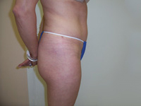After SmartLipo™