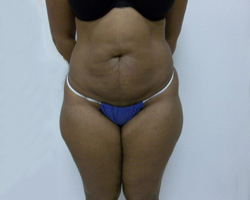 Before SmartLipo™
