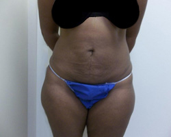 After SmartLipo™