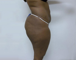 Before SmartLipo™