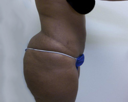 After SmartLipo™