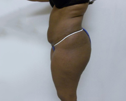 Before SmartLipo™