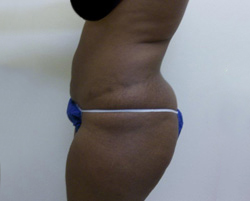 After SmartLipo™