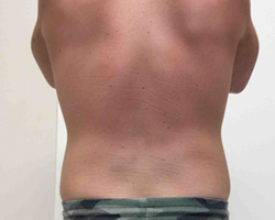 After SmartLipo™