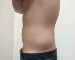 Before SmartLipo™