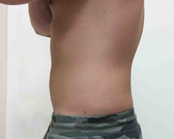 After SmartLipo™