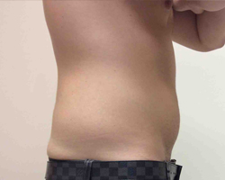 Before SmartLipo™