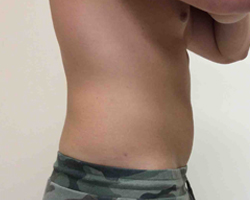 After SmartLipo™