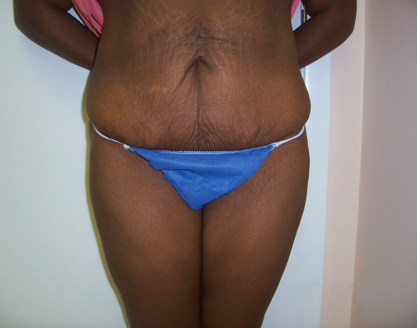 Before Tummy Tuck