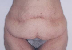 Before Tummy Tuck
