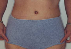 After Tummy Tuck