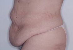 Before Tummy Tuck