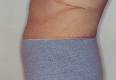 After Tummy Tuck