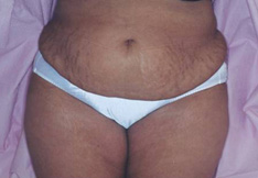 Before Tummy Tuck